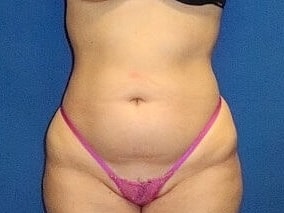 Liposuction Before & After