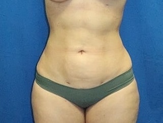 Liposuction Before & After