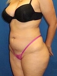 Liposuction Before & After