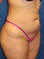 Liposuction Before & After