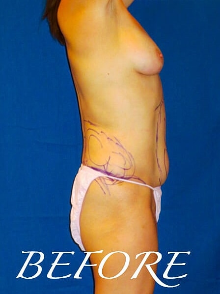 Liposuction Before & After