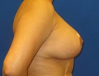 Breast Augmentation With Lift Before & After