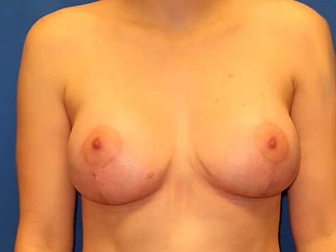 Breast Augmentation With Lift Before & After