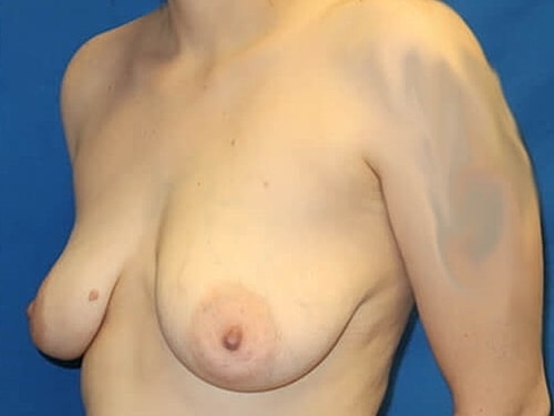 Breast Augmentation With Lift Before & After