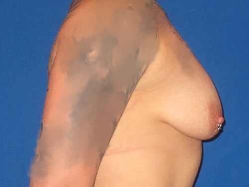 Breast Augmentation With Lift Before & After