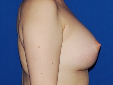 Breast Augmentation With Lift Before & After