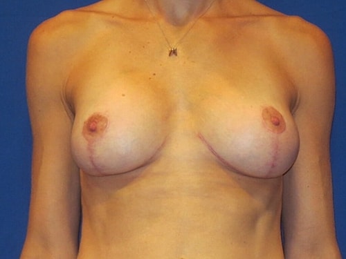 Breast Augmentation With Lift Before & After