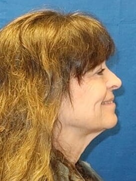 Facelift Before & After