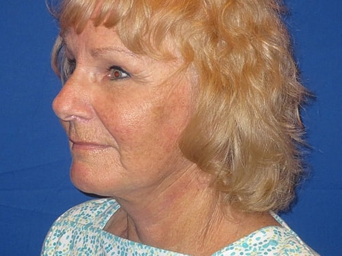 Facelift Before & After