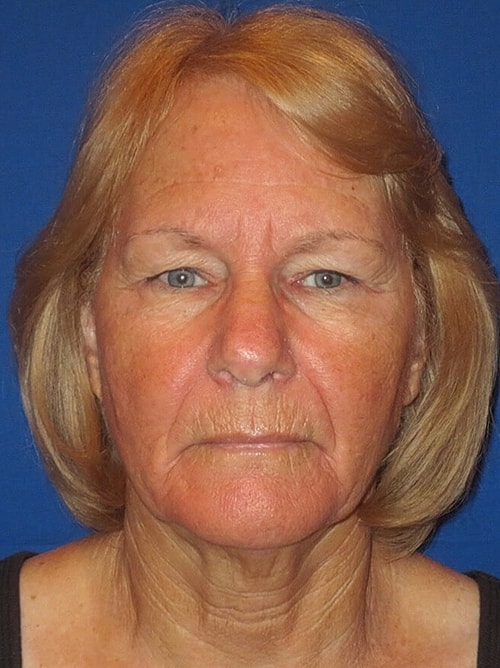 Facelift Before & After