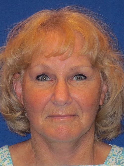 Facelift Before & After