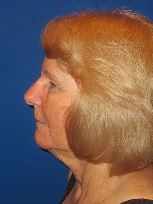 Facelift Before & After