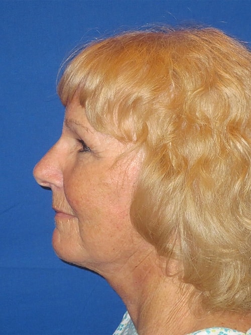 Facelift Before & After