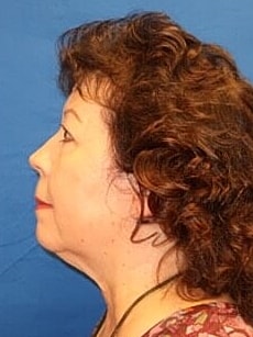 Facelift Before & After