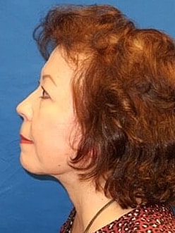 Facelift Before & After