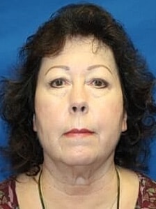 Facelift Before & After