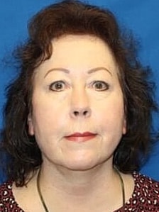 Facelift Before & After