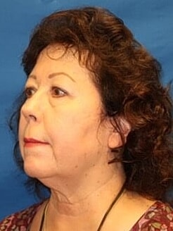 Facelift Before & After