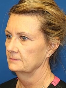 Facelift Before & After