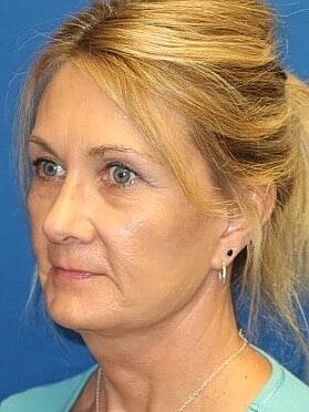 Facelift Before & After