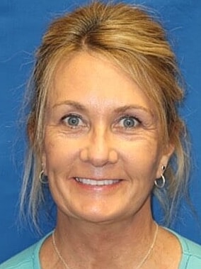 Facelift Before & After