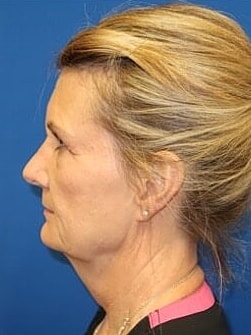 Facelift Before & After