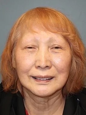 Facelift Before & After