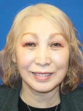 Facelift Before & After