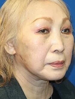Facelift Before & After