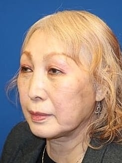 Facelift Before & After