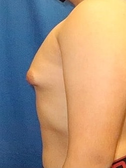 Gynecomastia Treatment Before & After