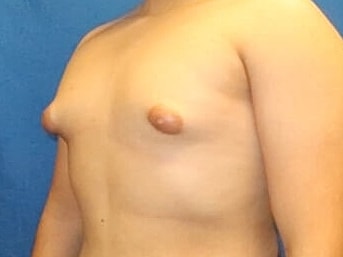 Gynecomastia Treatment Before & After