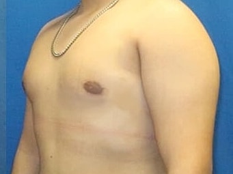 Gynecomastia Treatment Before & After