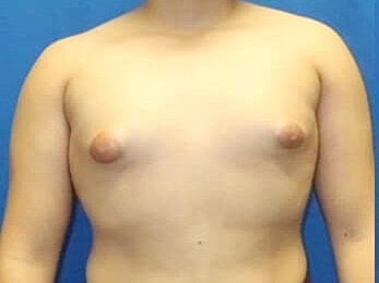Gynecomastia Treatment Before & After