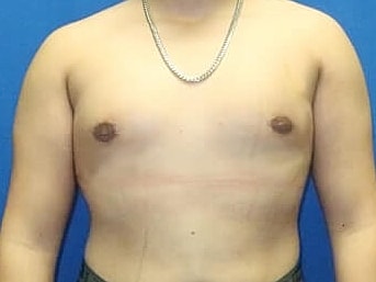 Gynecomastia Treatment Before & After