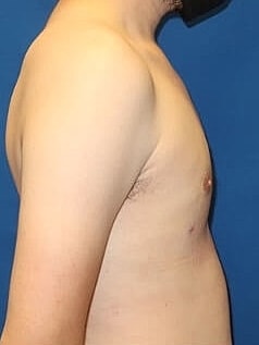 Gynecomastia Treatment Before & After