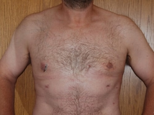 Gynecomastia Treatment Before & After