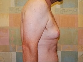 Gynecomastia Treatment Before & After