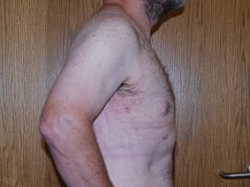 Gynecomastia Treatment Before & After