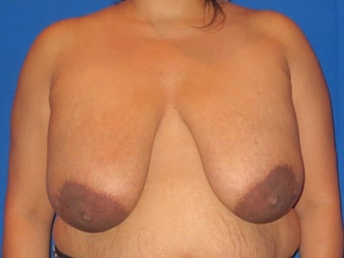 Breast Reduction Before & After