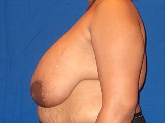 Breast Reduction Before & After