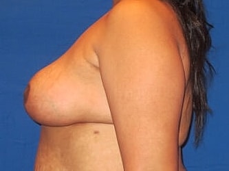 Breast Reduction Before & After