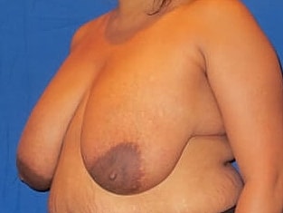 Breast Reduction Before & After