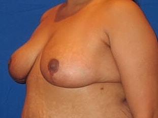 Breast Reduction Before & After