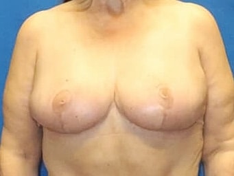 Breast Lift Before & After