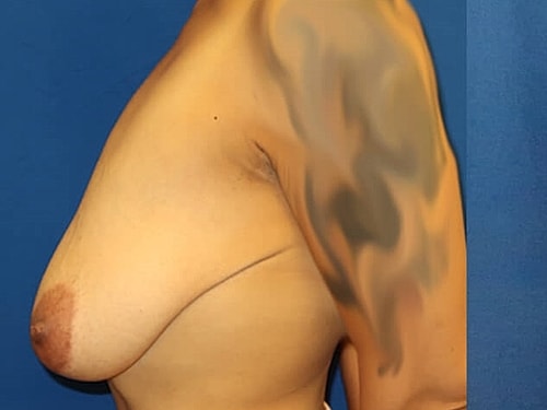 Breast Lift Before & After