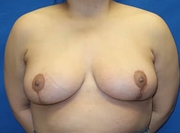 Breast Lift Before & After