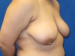 Breast Lift Before & After