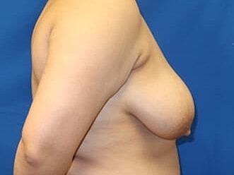 Breast Lift Before & After