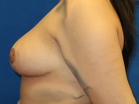 Breast Lift Before & After